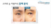 스마트 눈 지방이식-증례분석