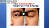 남성들의 두껍고 어색한 쌍꺼풀, 다중겹 쌍꺼풀 해결 방법