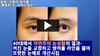 일명 '아줌마 쌍꺼풀' '빠꼼한 눈' 피하는 수술법 - 비 절개 상안검 수술(자연주의 눈성형)