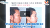 얼굴지방이식 실패 안하는 방법은?