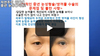 수술 한 티 안나는 자연주의 비절개 눈성형, 쌍꺼풀 수술-라인강화법-수술 전후사진-중년 눈성형-상안검수술-꺼진눈 지방이식-