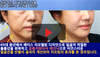 40대 이상에서 성공적인 얼굴지방이식을 위해 반드시 고려할 점!!